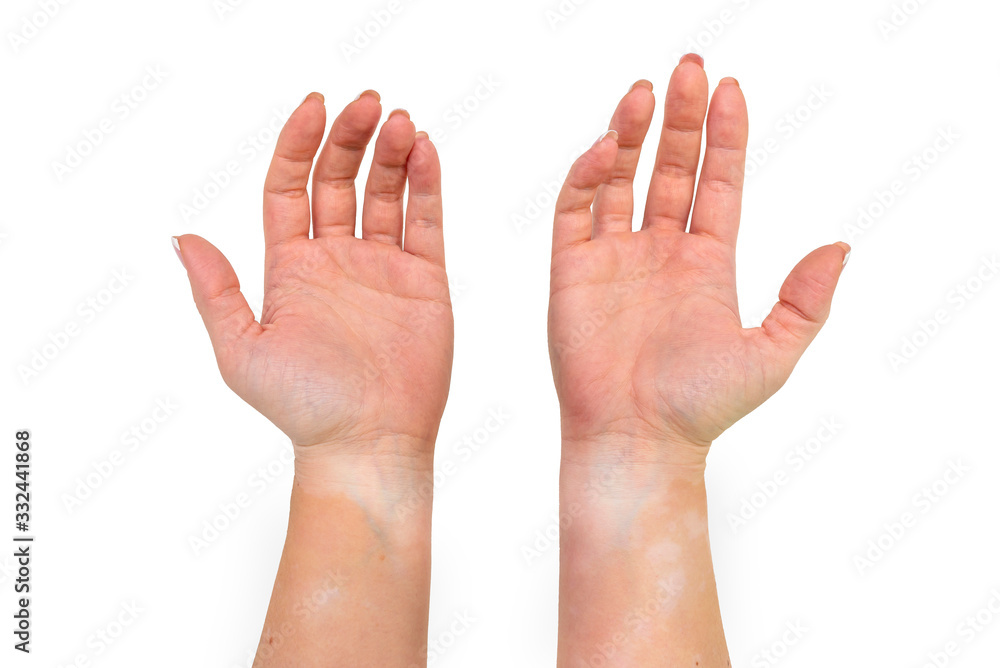 Stains from vitiligo disease on the inside of the hands and forearms of a young Caucasian woman, isolated on a white background with a clipping path. Stains from vitiligo disease on the inside of the hands and forearms of a young Caucasian woman, isolated on a white background with a clipping path.