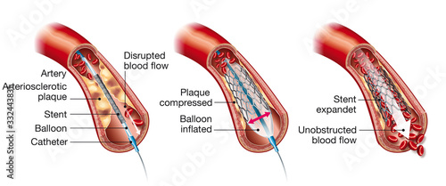 Arteriosclerosis, balloon angioplasty and stent insertion, medical illustration, labeled photo