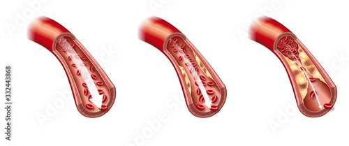 Arteriosclerosis, illustration showing healthy blood vessel and beginning of arteriosclerosis
