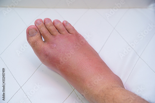 Wallpaper Mural Close up old man right foot, Ankle wounded waiting and swelling infectious disease by bee sting allergic reactions nurse treatment on wound dressing a bloody and brine of patient on white background