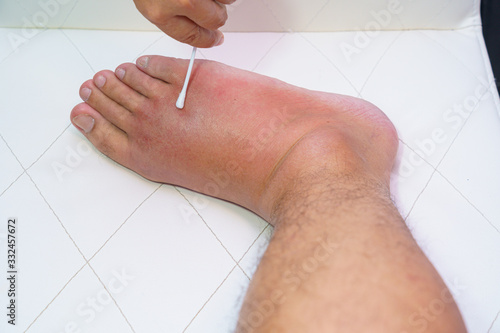 Close up old man right foot, Ankle wounded waiting and swelling infectious disease by bee sting allergic reactions nurse treatment on wound dressing a bloody and brine of patient on white background. photo
