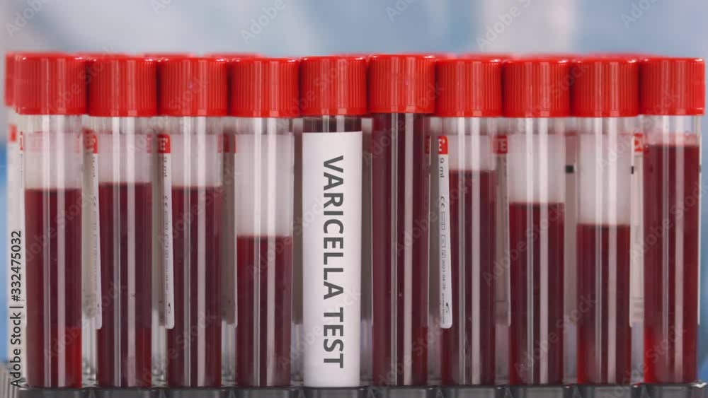 Hand wearing protection glove puts vial with varicella test in the tube rack Hand wearing protection glove puts vial with varicella test in the tube rack