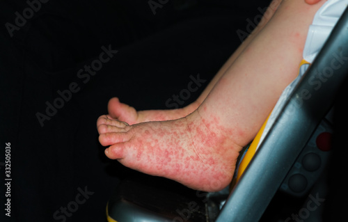A young boy with Hand, Foot and Mouth disease. photo