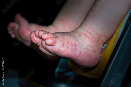 A young boy with Hand, Foot and Mouth disease. photo