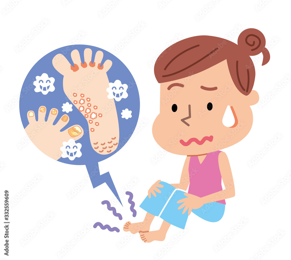 水虫 爪水虫 女性 Stock イラスト Adobe Stock 水虫 爪水虫 女性 Stock イラスト Adobe Stock
