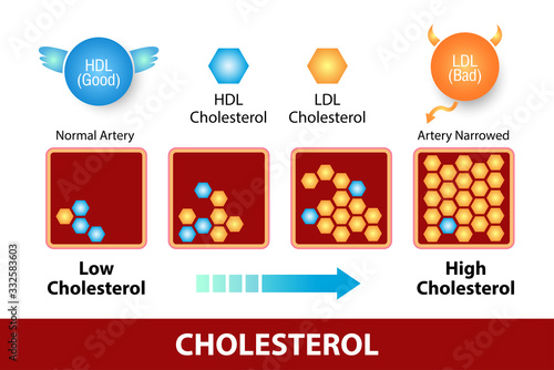 Cholesterol in artery, health risk