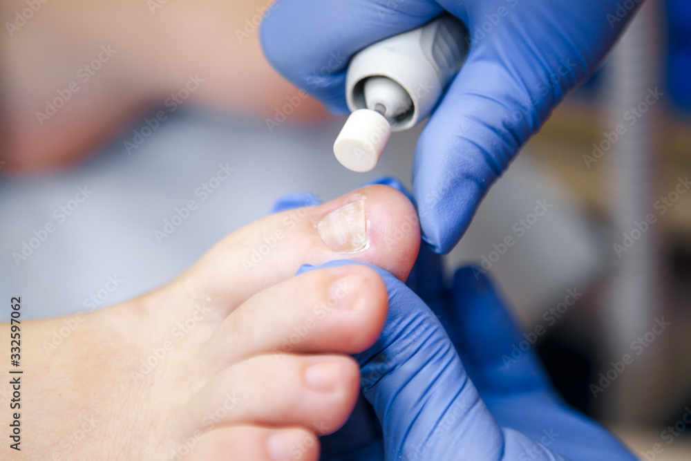 Podology treatment. Podiatrist treating toenail fungus. Doctor removes calluses, corns and treats ingrown nail. Hardware manicure. Health, body care concept. Selective focus. Podology treatment. Podiatrist treating toenail fungus. Doctor removes calluses, corns and treats ingrown nail. Hardware manicure. Health, body care concept. Selective focus.