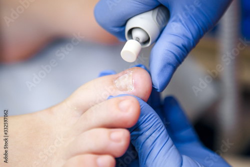 Podology treatment. Podiatrist treating toenail fungus. Doctor removes calluses  corns and treats ingrown nail. Hardware manicure. Health  body care concept. Selective focus.
