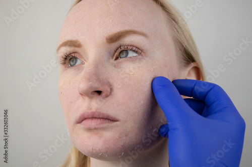 A woman examines dry skin on her face. Peeling, coarsening, discomfort, skin sensitivity. Patient at the appointment of a dermatologist or cosmetologist, selection of cream for dryness photo