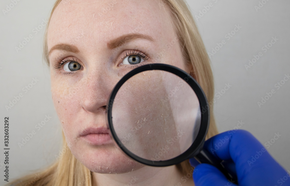 A woman examines dry skin on her face. Peeling, coarsening,