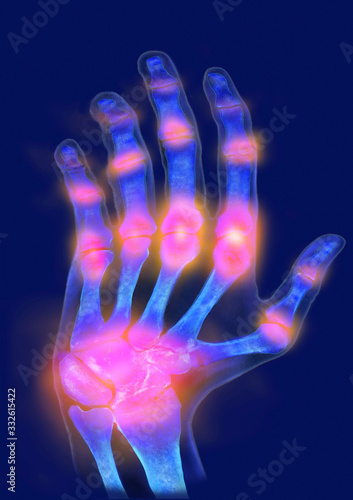 Hand, Gicht, verkrüppelt, Schmerzzonen, Illustration, Computertomographie © Aggi Schmid