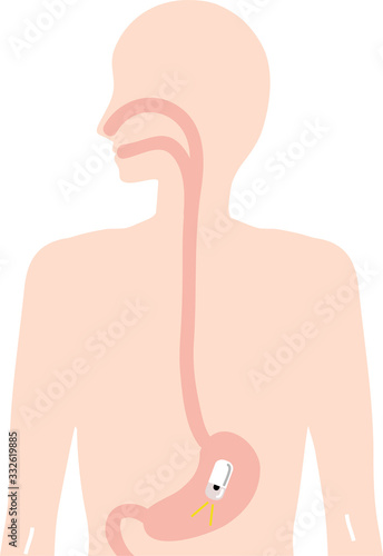 胃カメラ　検査　（カプセル）