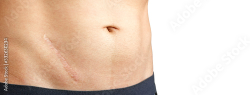 Scar on abdomen after removal of appendicitis. Banner with copy space photo