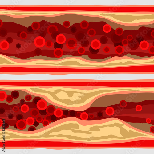artery set with blood cells