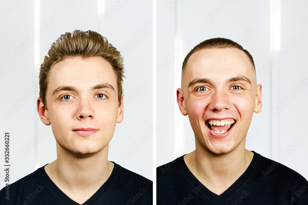 Portrait of young man before arter haircut with hair loss: bald and pompadour, transplant and transformation Portrait of young man before arter haircut with hair loss: bald and pompadour, transplant and transformation