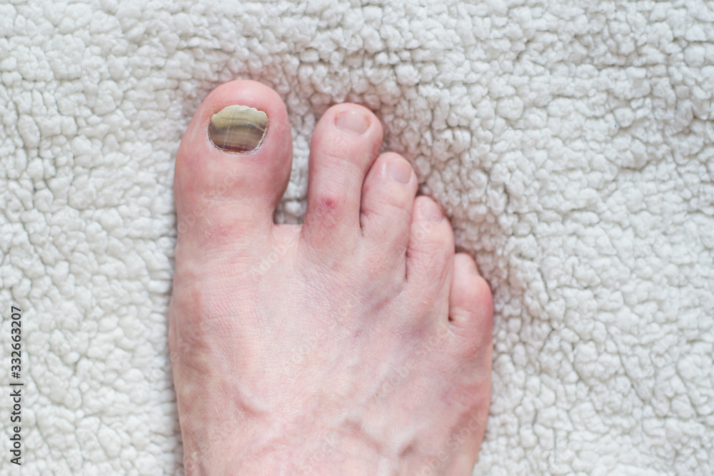 Nail injury Treatment of bruises and fractures. Damage to the nail phalanx. The effect of wearing uncomfortable shoes. Pedicure and podiatry. selective focus. Nail injury Treatment of bruises and fractures. Damage to the nail phalanx. The effect of wearing uncomfortable shoes. Pedicure and podiatry. selective focus.