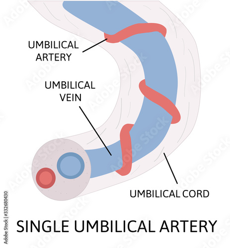 Single umbilical artery. anatomy of umbilical cord with one umbilical artery and one umbilical vien.