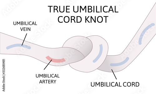 True umbilical cord knot. umbilical cord forms a knot inside the womb. Danger for child.