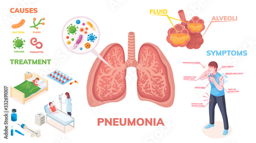 Pneumonia lungs disease vector infographics on symptoms, cause and medical treatment. Pneumonia lungs infection bacteria and viruses, disease symptoms, transmission prevention and hospitalization photo