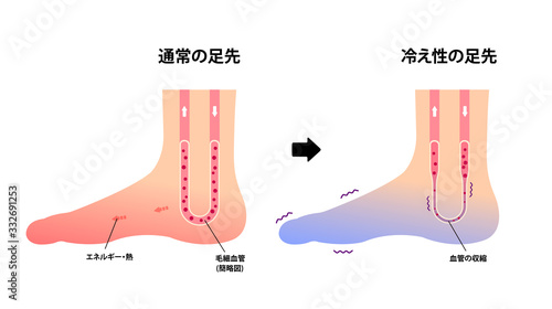 通常の足と末端冷え性の足 比較イラスト (冷え性の原因) 