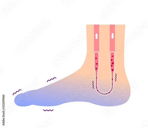 Cold foot blood circulation illustration (sensitivity to cold, cold toes) / No text