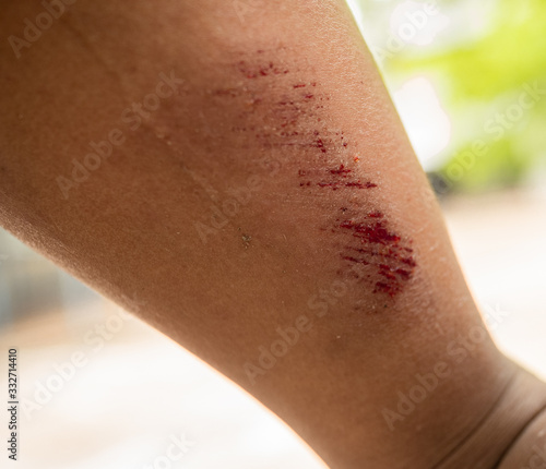 The fresh wound in the right leg was caused by a 6-year-old boy riding a bicycle accident.