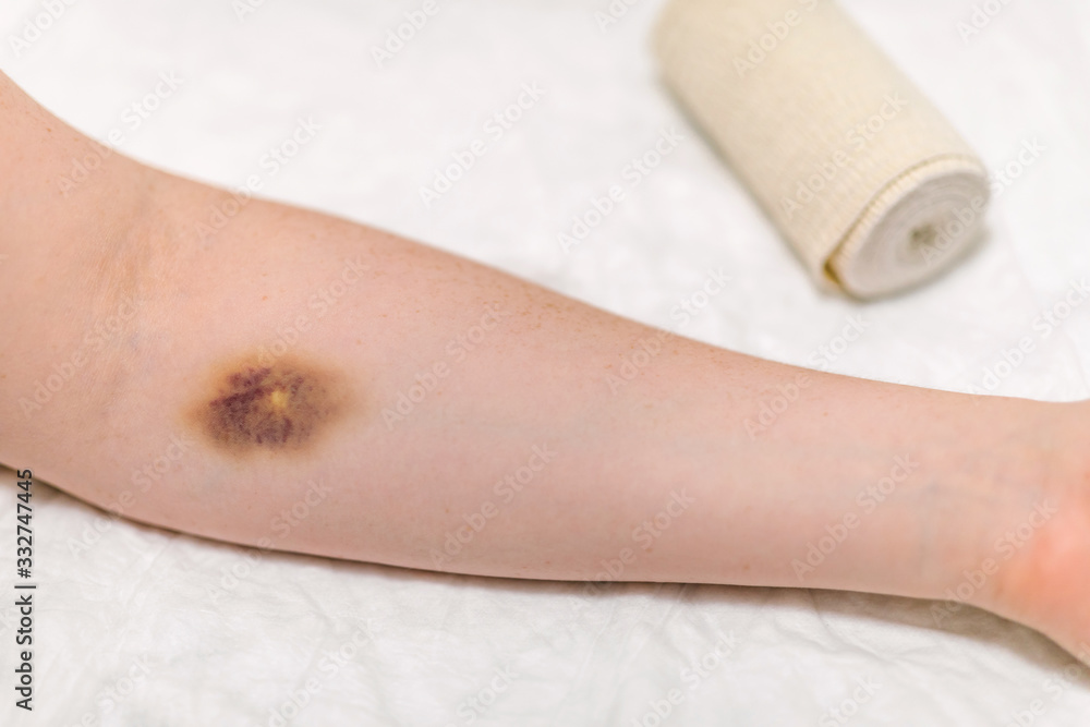 First aid for bruising. Large hematoma bruise on the arm, ointment and bandage First aid for bruising. Large hematoma bruise on the arm, ointment and bandage