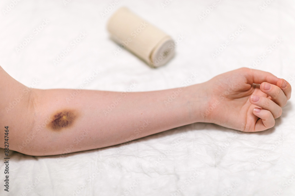 First aid for bruising. Large hematoma bruise on the arm, ointment and bandage First aid for bruising. Large hematoma bruise on the arm, ointment and bandage