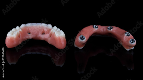 Dental dentures for the lower and upper jaw, shot from the back on a black background