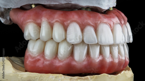 dental dentures for the lower and upper jaws on the dental model in the bite