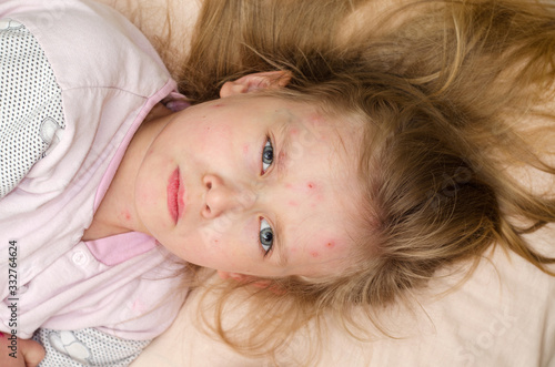 Fotografie Little baby girl lies on a bed with chickenpox