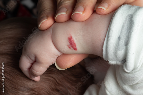 Angioma or pink hemangioma on the arm of a two-month-old baby