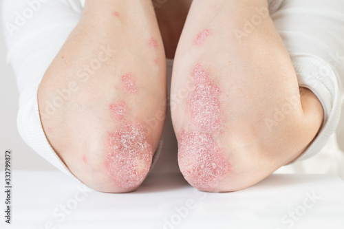 Acute psoriasis on the elbows is an autoimmune incurable dermatological skin disease. Large red, inflamed, flaky rash on the knees. Joints affected by psoriatic arthritis © SNAB