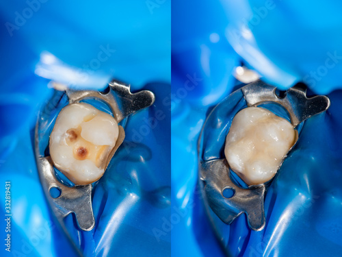 treatment of tooth decay with subsequent filling with photopolymer material. Close-up, macro photo