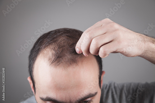 Caucasian man checking his hair. Hair loss problem