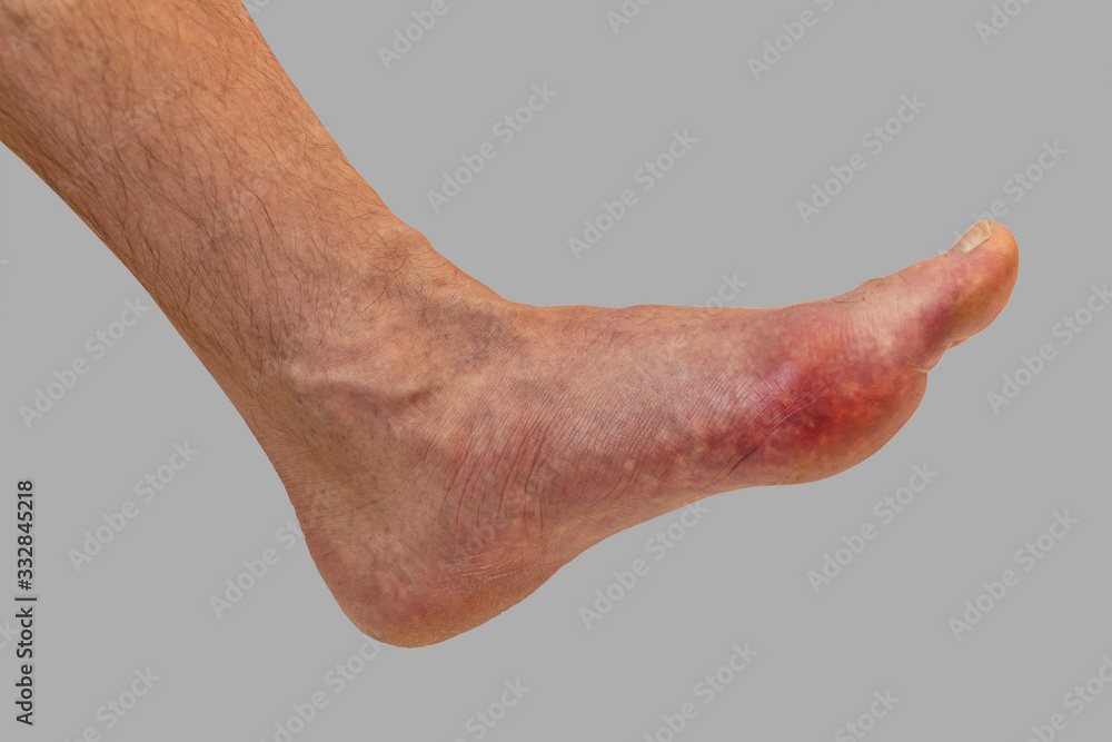 Foto de Foot disease Rheumatism and gout. Red leg swelling. Pain in the