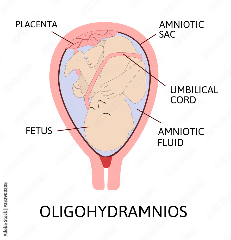 Obraz premium Oligohydramnios, deficiency of amniotic fluid. Parts of pregnancy are marked with line
