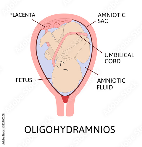 Oligohydramnios, deficiency of amniotic fluid. Parts of pregnancy are marked with line