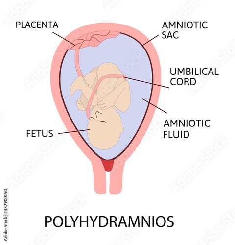 Polyhydramnios. excess of amniotic fluid in the amniotic sac.