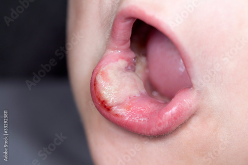 sick boy with big haze on his lips