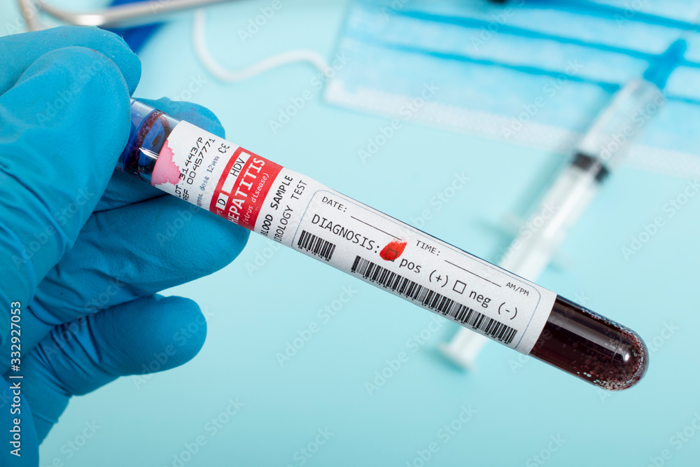 Naklejka premium Blood samples with infected virus