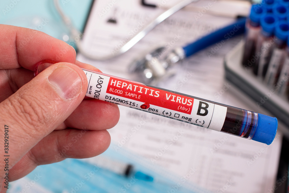 Fototapeta premium Blood samples with infected virus