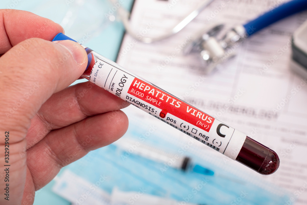 Fototapeta premium Blood samples with infected virus