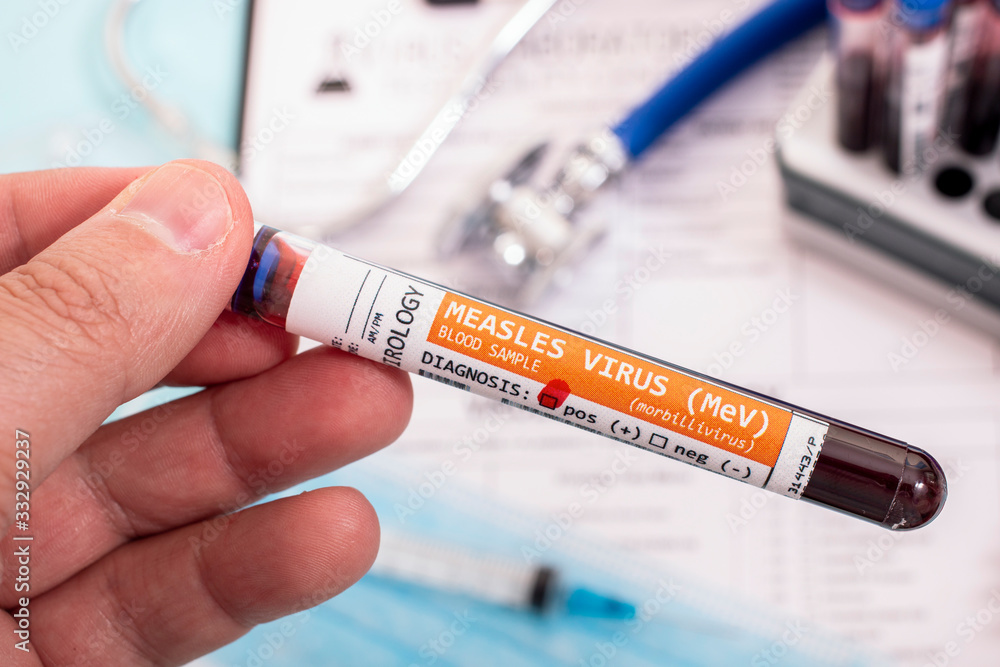 Fototapeta premium Blood samples with infected virus