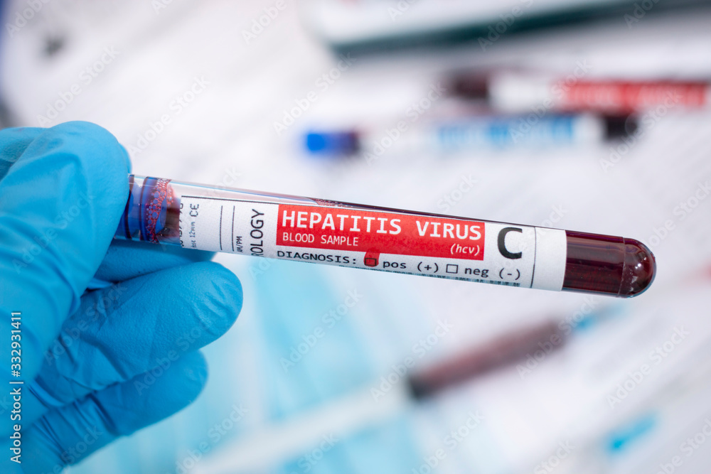 Fototapeta premium Blood samples with infected virus
