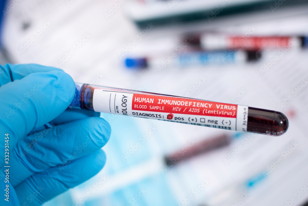 Fototapeta premium Blood samples with infected virus