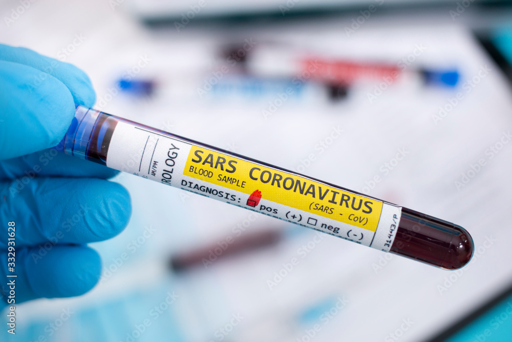 Fototapeta premium Blood samples with infected virus