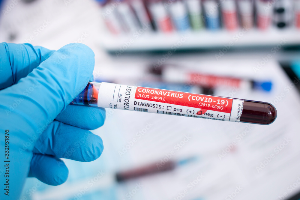 Fototapeta premium Blood samples with infected virus
