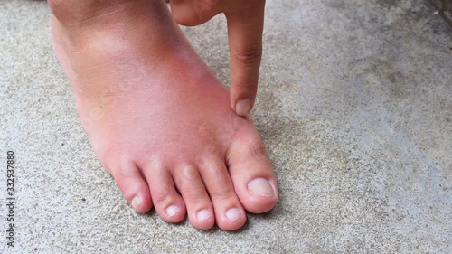 Close up old man right foot, Ankle wounded waiting and swelling infectious disease by bee sting allergic reactions nurse treatment on wound dressing a finger touch press nursing on white background. photo