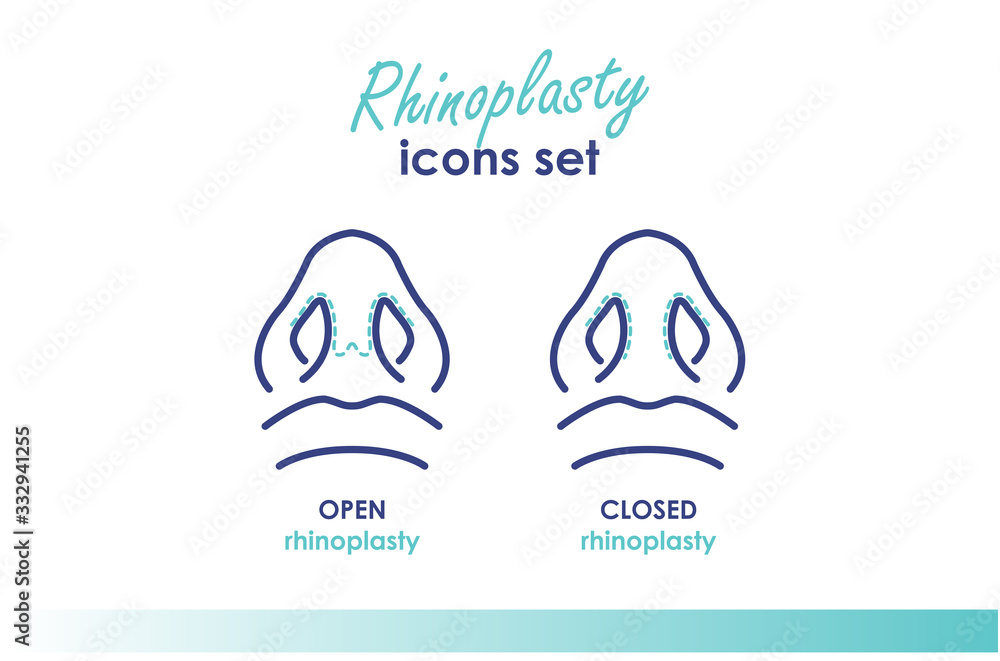 Rhinoplasty. Open and closed rhinoplasty. Plastic surgery nose. Bottom view. Medical and beauty illustration Rhinoplasty. Open and closed rhinoplasty. Plastic surgery nose. Bottom view. Medical and beauty illustration